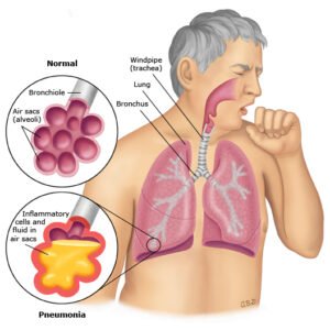 Marie Manga Pneumonia Supplement