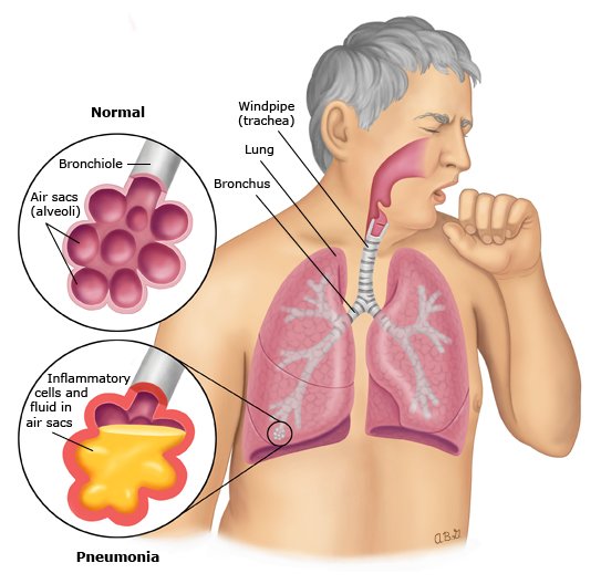 Marie Manga Pneumonia Supplement